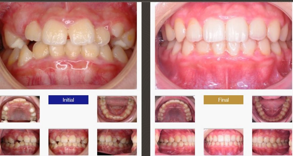 Smile Gallery By Marlborough Orthodontics | Amazing Smile Transformations